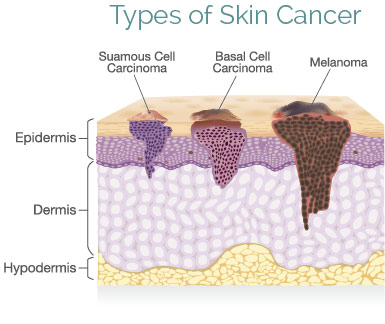 MOHS SURGERY - Dermatology Consultants of Marin